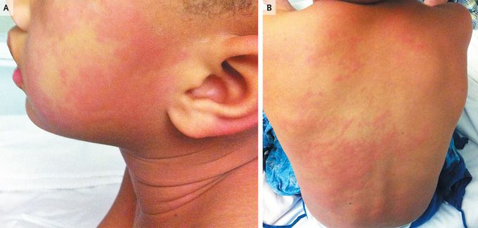 Scombroid Poisoning