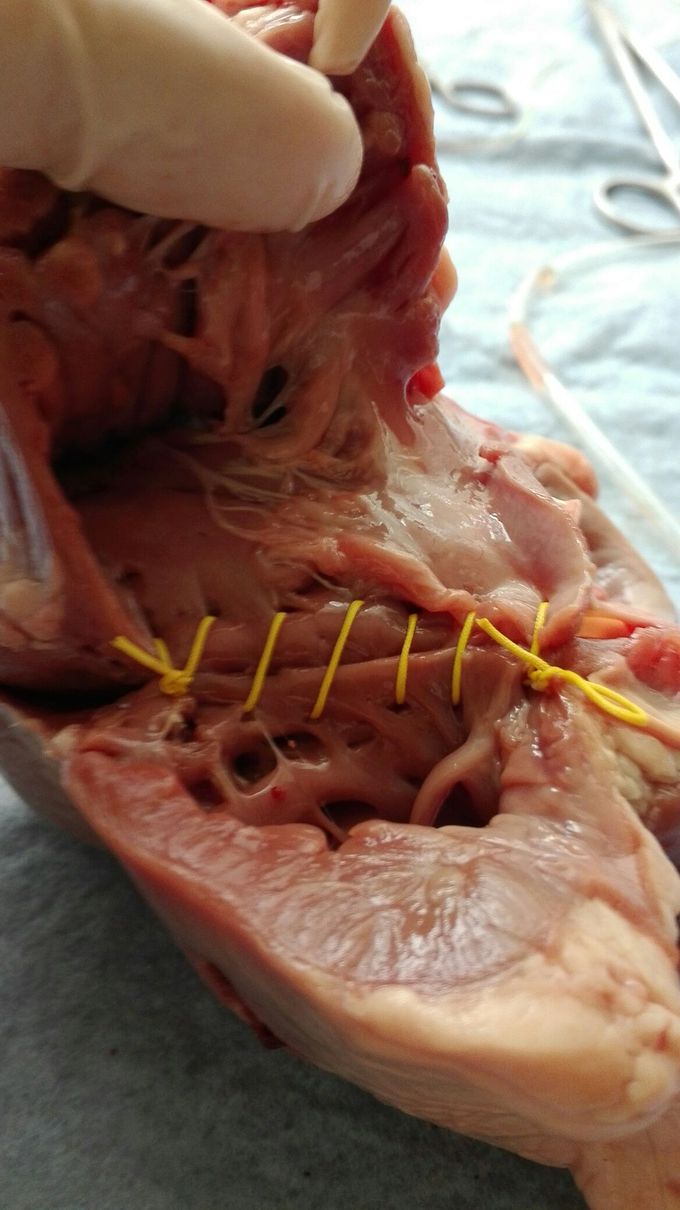 Suture