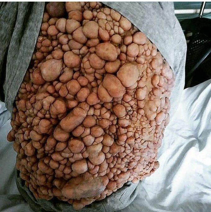 Neurofibromatosis