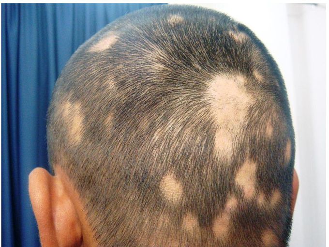 Male shown in the figure is likely to be affected by???
