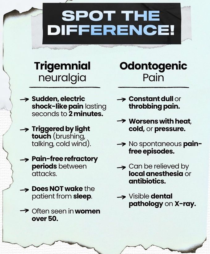 Trigeminal Neuralgia IV