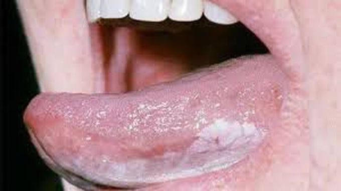 Causes of leukoplakia