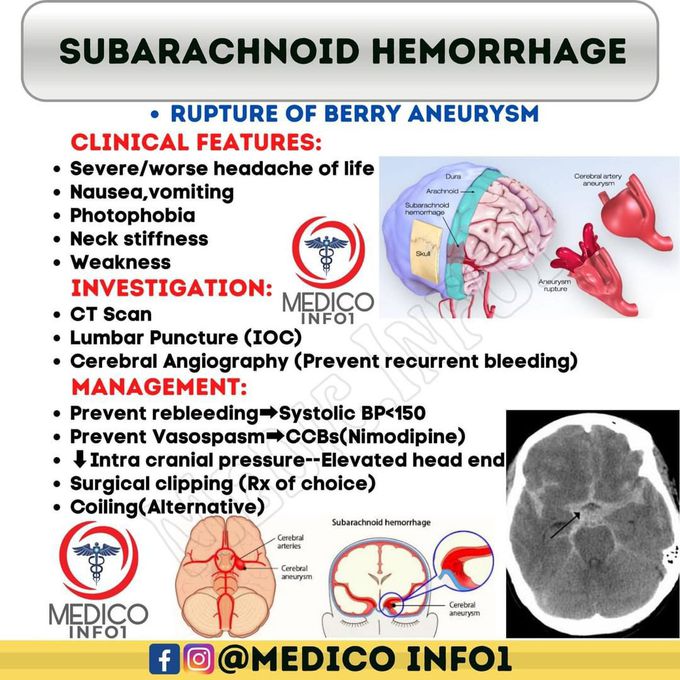 Subarachnoid Hemorrhage