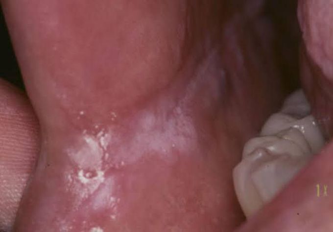 atrophic candidiasis