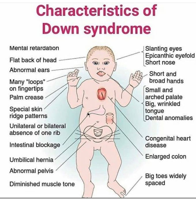 Down Syndrome