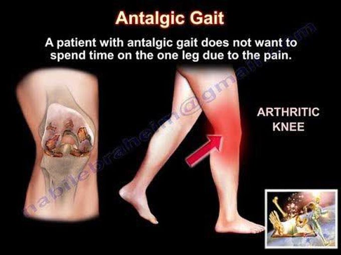 Antalgic Gait