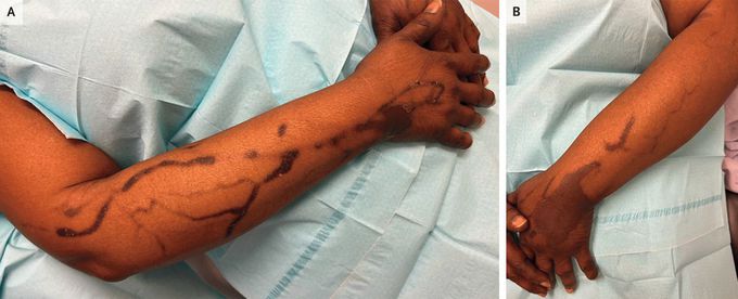 Serpentine Supravenous Hyperpigmentation