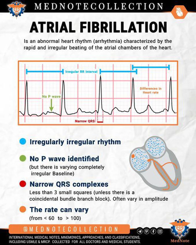 🧠 ATRIAL FIBRILLATION