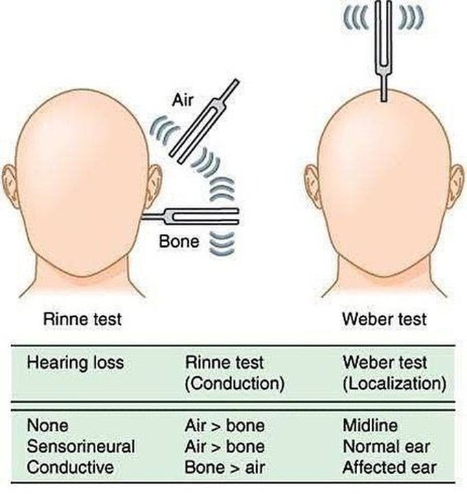 Rinne Vs Weber test