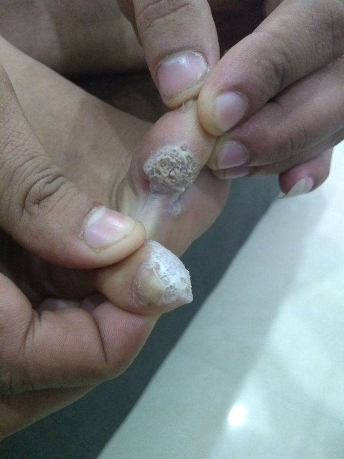 Diagnosis ?