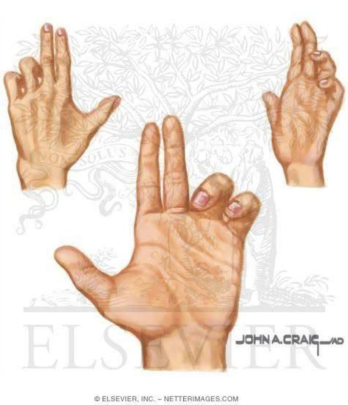 Hand of Benediction- Median Nerve Injury