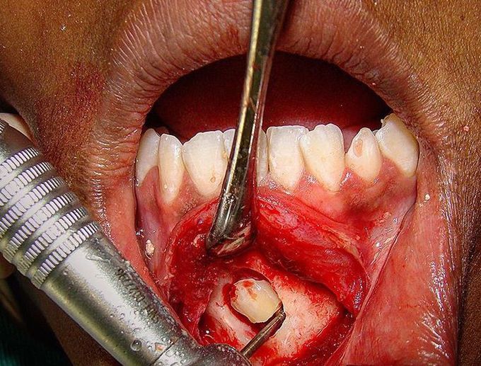 Removing  an impacted mandibular canine 💀🔪Oral and Maxillofacial surgery💀⛏