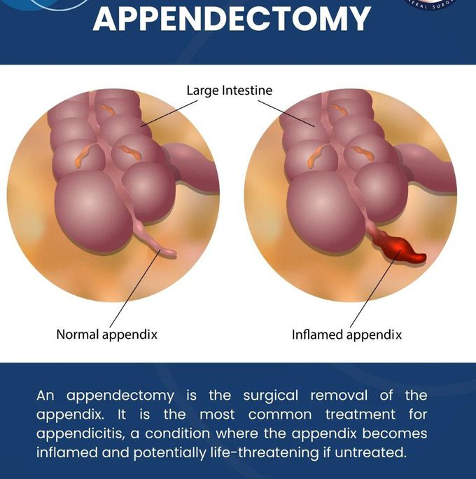 Appendectomy