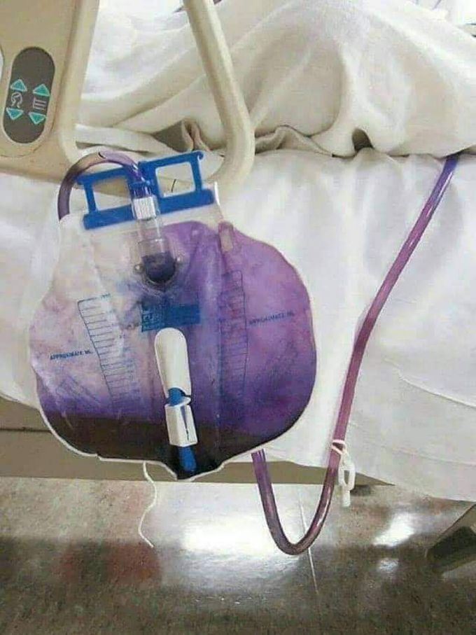An amazing case of Purple Urine !! 😮