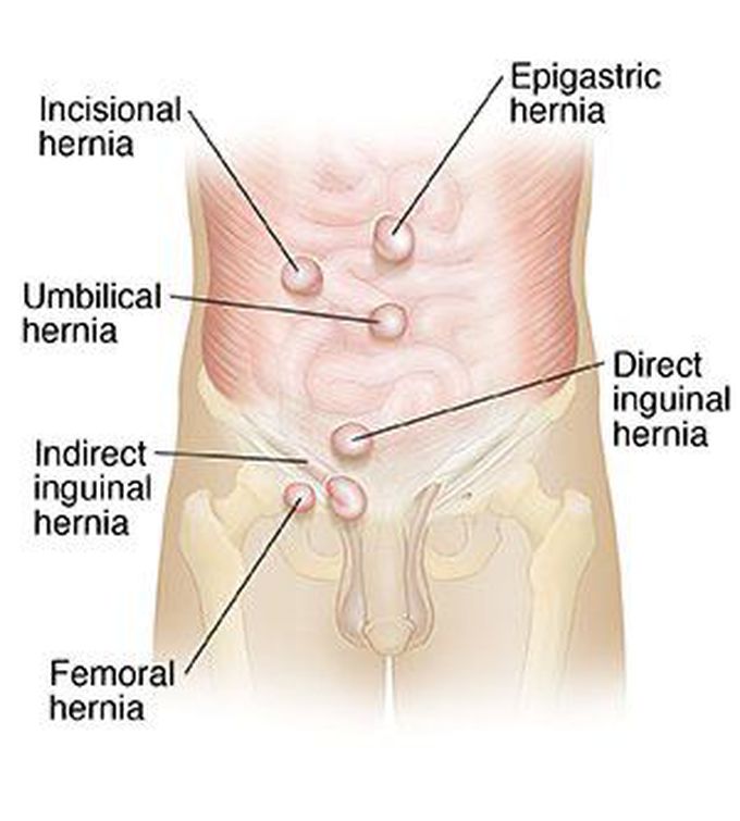 Hernia