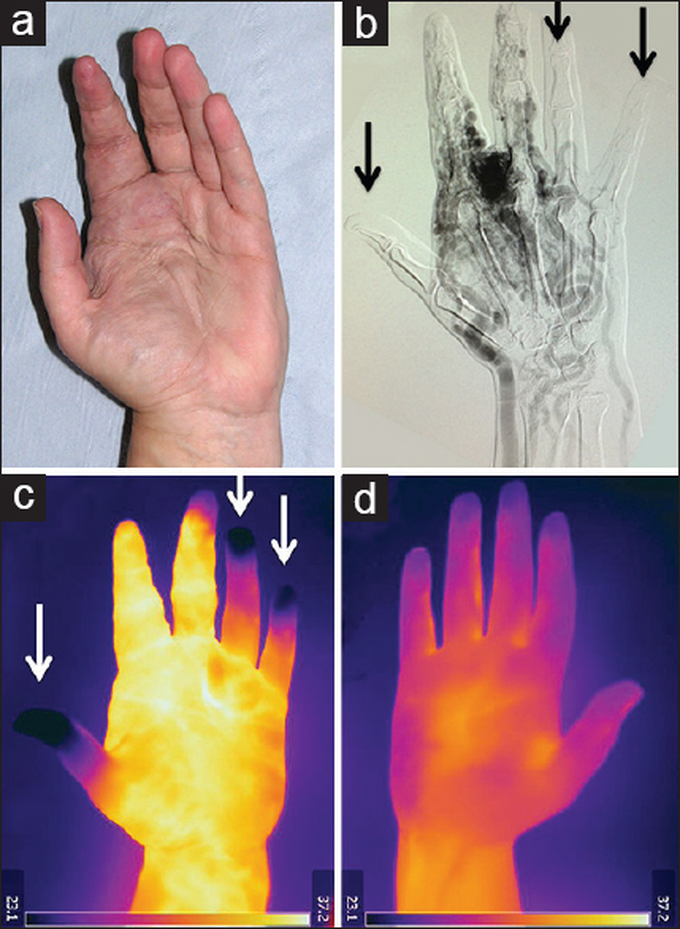 An arteriovenous malformation under a thermograph