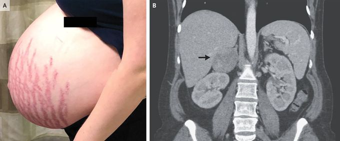 Striae and an Adrenal Mass