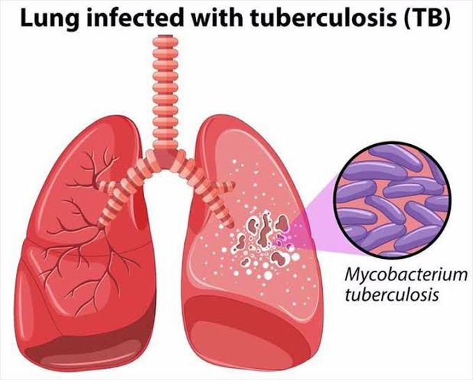 Treatment of TB