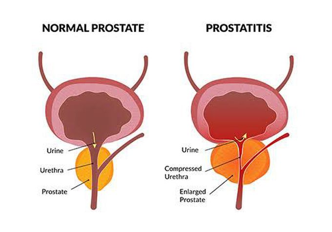 Symptoms of prostatitis