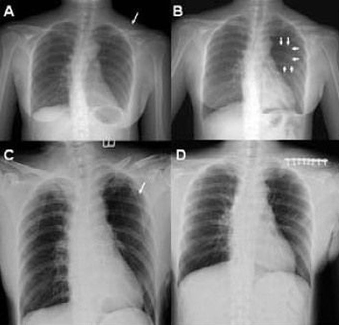 Delayed Traumatic Pneumothorax