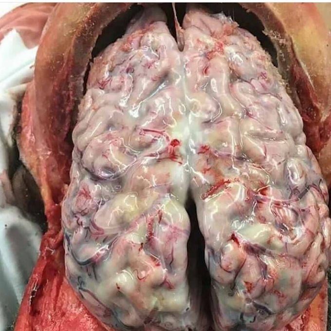 Meningitis