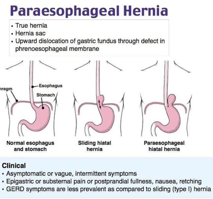Para-esophageal Hernia