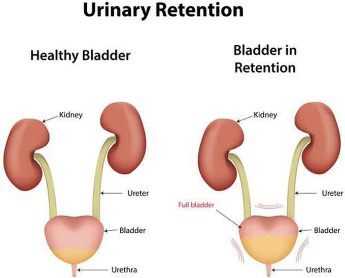 Difference betweeb urine retention and Anuria by History and simple general examination