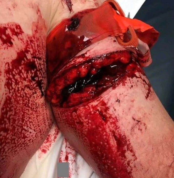 Severe Bicep and Cephalic Vein Injury