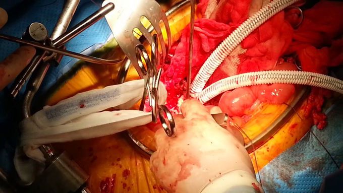 How I perform the open repair of ruptured abdominal aortic aneurysms
