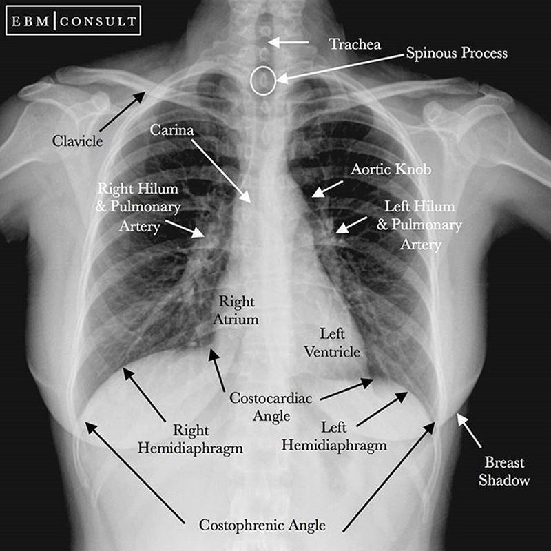 Anatomy Of Chest X Ray Radiology Normal Chest X Rays Glass Box Many