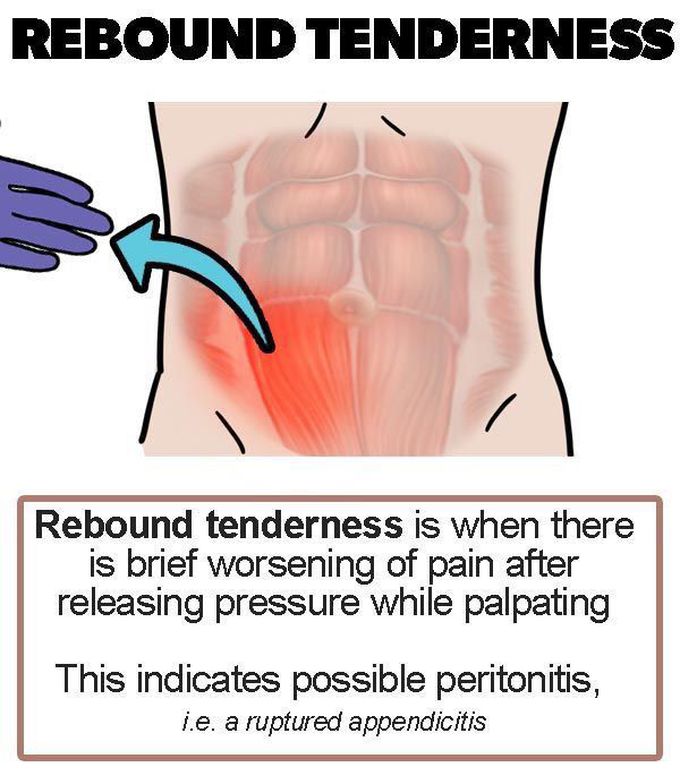 rebound-tenderness-medizzy