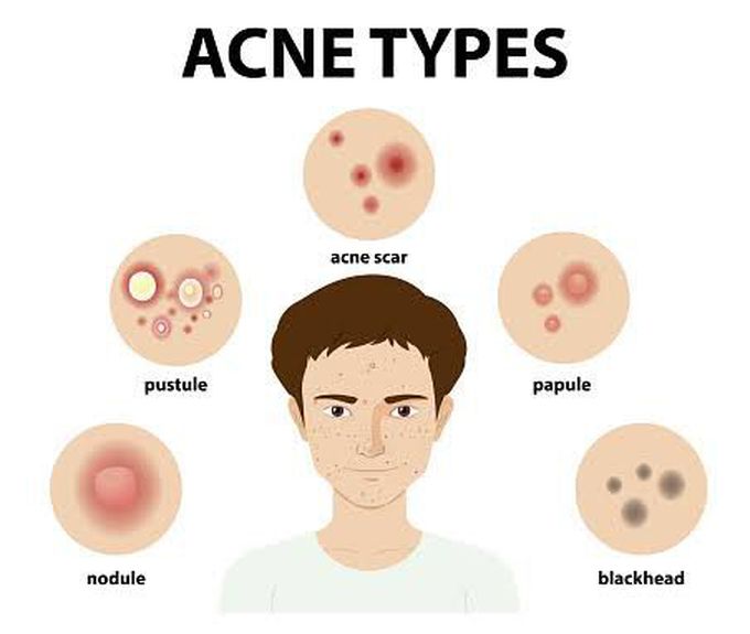 Types of Acne - MEDizzy