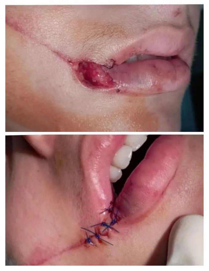 Right Commisure Laceration Repair