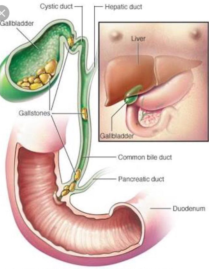 Gallstones