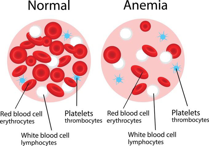 Anemia can make you feel tired and short of breath. Here are some other signs:

~Your skin looks pale or yellow.
~You feel dizzy.
~You have no appetite.
~You've lost weight without trying.
~Your hands and feet feel like they're numb or tingling.
~Your heart beats too fast or you have chest pain.
~Your muscles feel weak.
~You often have mood changes.
~You're confused or forgetful.