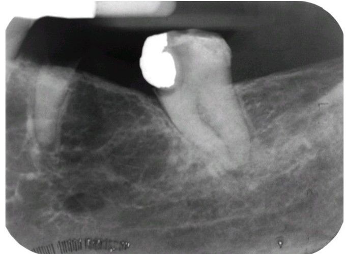 Focal Osteoporotic Marrow Defect