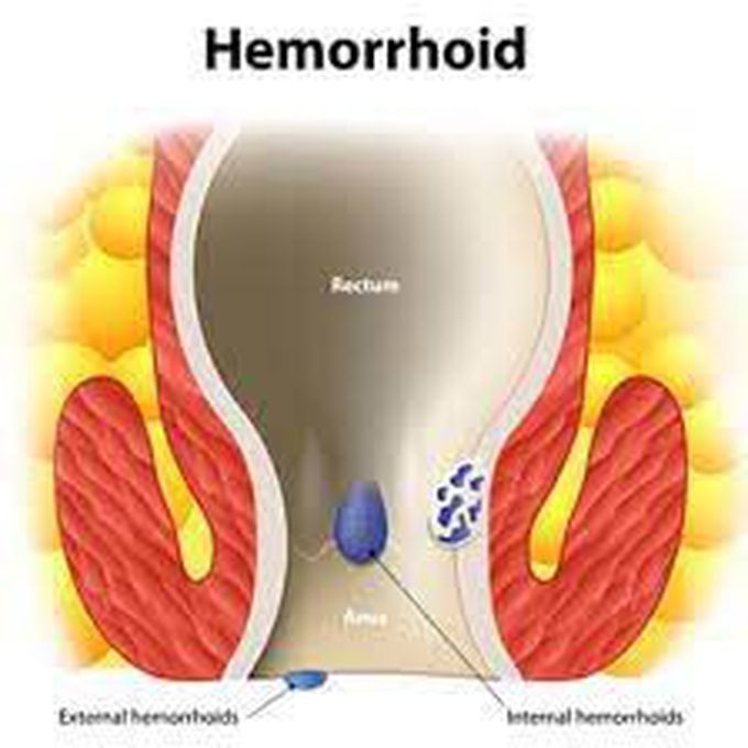 What causes hemorrhoids?