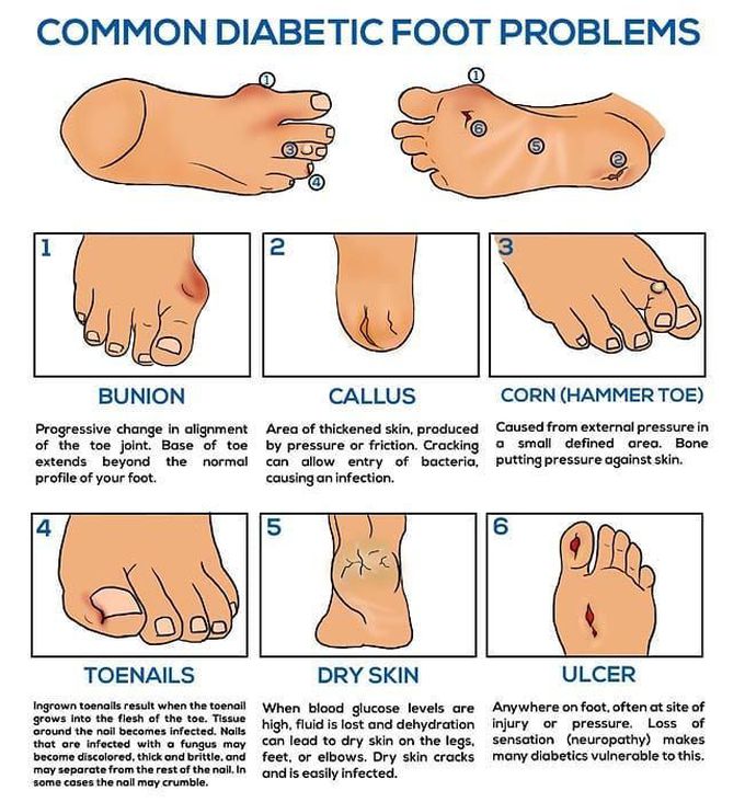 Diabetic foot