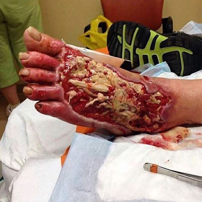 Extensive diabetic foot ulcer