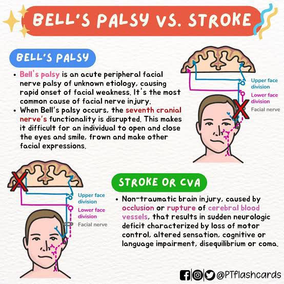 Bell's Palsy Vs Stroke MEDizzy