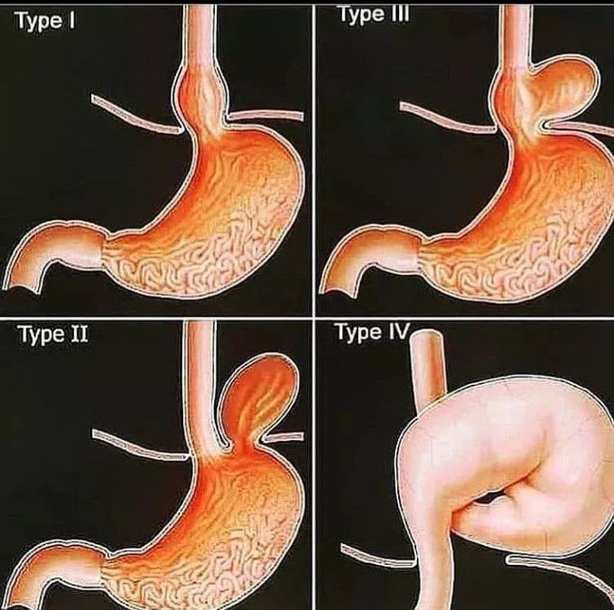 Hiatal hernia