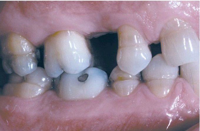 Environmental enamel hypoplasia