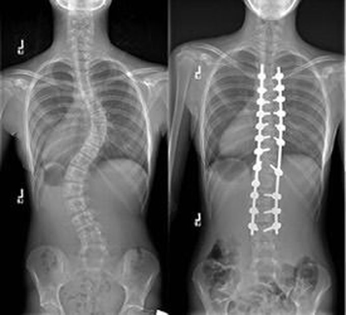 Scoliosis