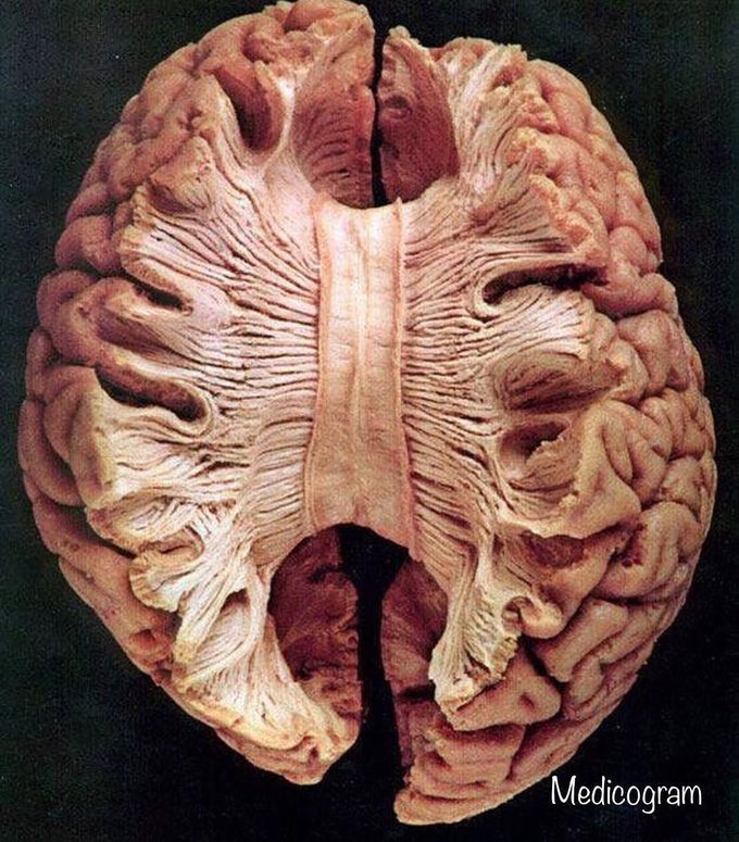 The Corpus Callosum