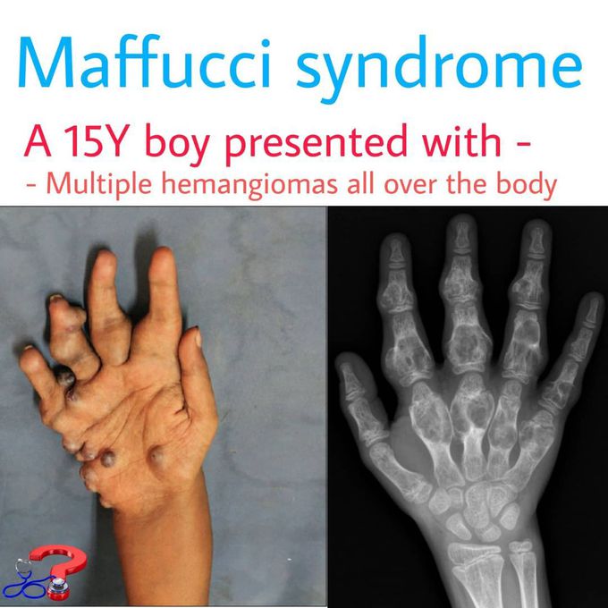 Maffucci Syndrome