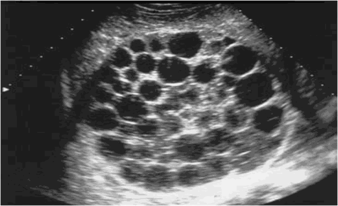 Hydatid Liver Cysts