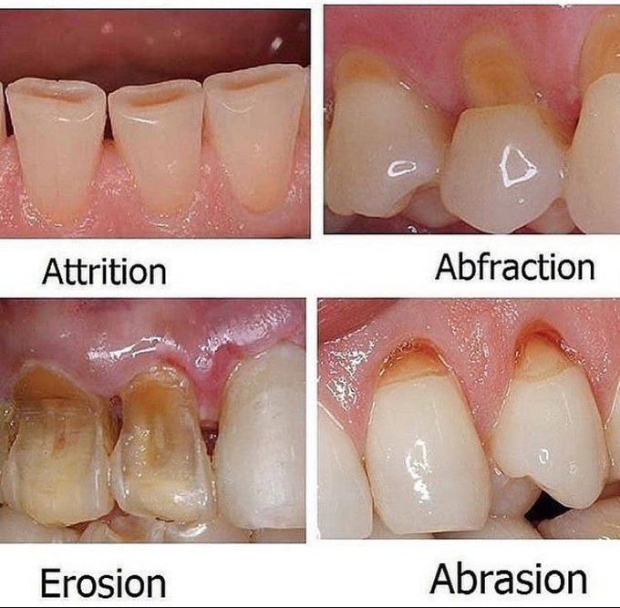 Types of tooth wear