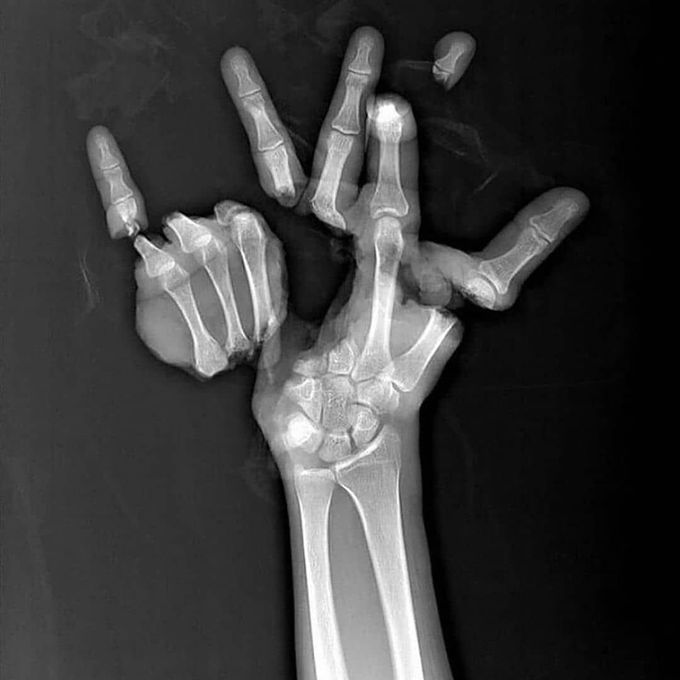 Severe Hand Trauma!
