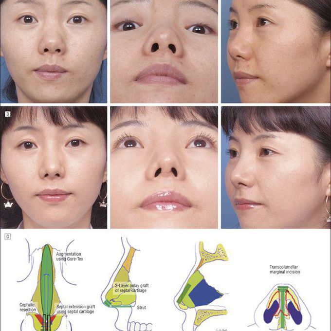 Augmentation Rhinoplasty