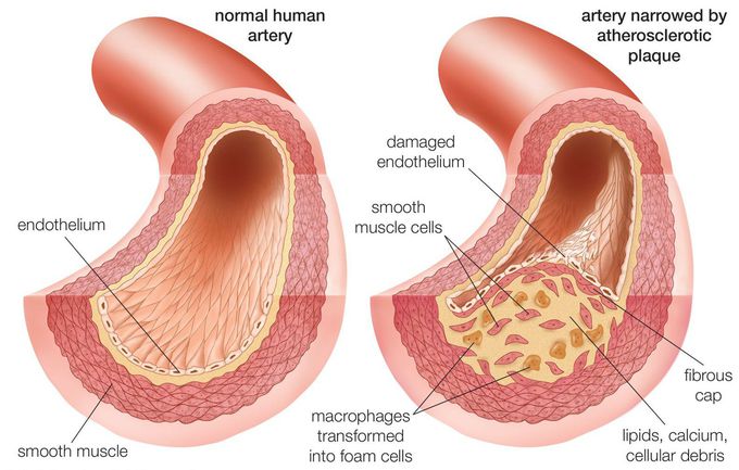 What is the main cause of hypercholesterolemia?